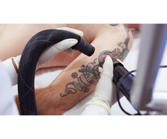 Tattoo Pigment Removal At Honolulu | free-classifieds-usa.com - 1