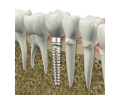 Dental Implant Clinic San Jose | Dentist Office In San Jose | free-classifieds-usa.com - 2