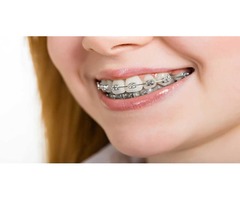 Wear right braces and feel confident with your smile | free-classifieds-usa.com - 1
