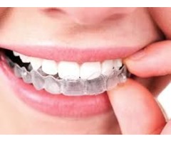 Benefit from the Invisalign system and smile freely | free-classifieds-usa.com - 2