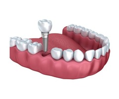 Dental Clinic In San Jose | Dental Implants In San Jose | free-classifieds-usa.com - 2