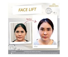 Top Cosmetic/Plastic surgery in Thailand Liposuction, Breast augmentation, Face Lift and more | free-classifieds-usa.com - 2