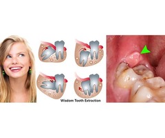 Best dentist in Auburn | Wisdom tooth extraction Auburn WA | free-classifieds-usa.com - 1