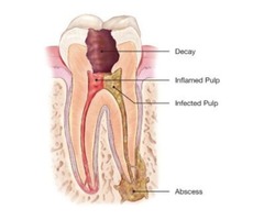Root Canal Therapy in irvine ca | free-classifieds-usa.com - 1
