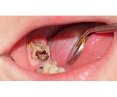 Get an Affordable Tooth Cavity Treatment San Fernando | free-classifieds-usa.com - 1