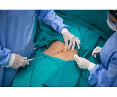 Liposuction Surgeon in Dallas | free-classifieds-usa.com - 1