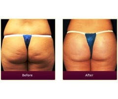 Top Rated Plastic Surgeon in Orange County - For Brazilian Butt Augmentation | free-classifieds-usa.com - 1