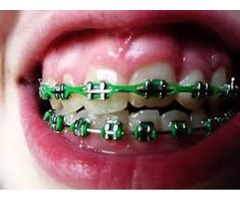 orthodontic braces | free-classifieds-usa.com - 1
