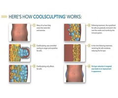 Cost Of Cool Sculpting Chin | free-classifieds-usa.com - 1