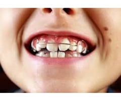 straighter teeth | free-classifieds-usa.com - 1