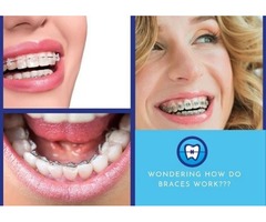 How Do Braces Work To Straighten Your Teeth? | free-classifieds-usa.com - 1