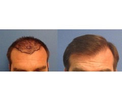 Best Hair Replacement | free-classifieds-usa.com - 1