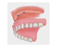  Affordable Fixed Dentures in Gilbert AZ | free-classifieds-usa.com - 1
