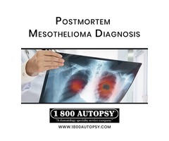 Postmortem Mesothelioma Diagnosis | free-classifieds-usa.com - 1