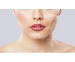  Best Acne Treatment for Women | free-classifieds-usa.com - 1