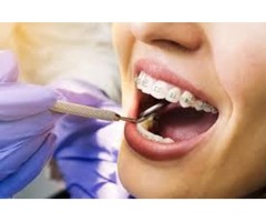 Dental Braces For Adults | free-classifieds-usa.com - 1