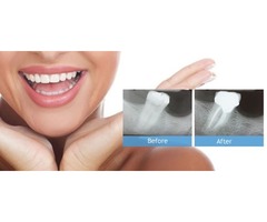 Cracked Tooth? Instant Dental Treatment by Emergency dentist in Raleigh NC | free-classifieds-usa.com - 2