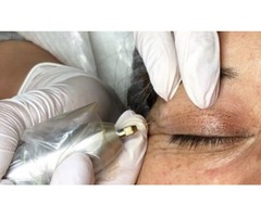 EYELID LIFT - NON SURGICAL BLEPHAROPLASTY NYC | free-classifieds-usa.com - 1