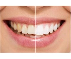 Professional Teeth Whitening | free-classifieds-usa.com - 1