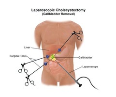 Laparoscopic Cholecystectomy | SURGERY FOR GALLBLADDER REMOVAL | free-classifieds-usa.com - 1