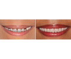 Best Dentist Frisco TX | free-classifieds-usa.com - 1