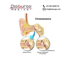 Cholesteatoma | Endoscopic Instruments | free-classifieds-usa.com - 1