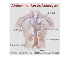 Prevention of Abdominal Aortic Aneurysm | free-classifieds-usa.com - 1