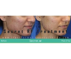 Get Secret RF treatment offered at Transformations Aesthetics | free-classifieds-usa.com - 1