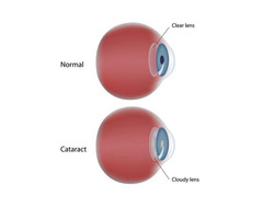 Affordable Cataract Surgery Bowling Green | Vision Associates | free-classifieds-usa.com - 1