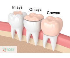 Porcelain Inlay and Onlay in Roswell GA | free-classifieds-usa.com - 1