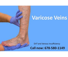 DVT and Venous Insufficiency Treatment | free-classifieds-usa.com - 1