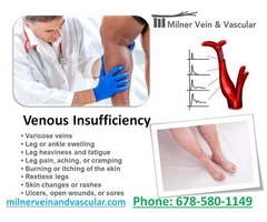 Best Venous insufficiency treatment in Snellville | free-classifieds-usa.com - 1