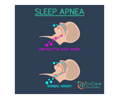 Sleep apnea treatment in Roswell GA | free-classifieds-usa.com - 1