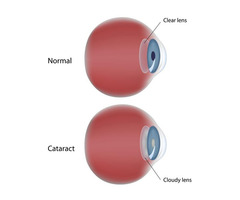 Best Cataract Surgery Bowling Green | Vision Associates | free-classifieds-usa.com - 1