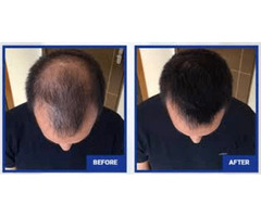 Folisin: To prevent hair loss in Men | free-classifieds-usa.com - 2
