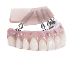 Pinnacle Dental In Plano | free-classifieds-usa.com - 1