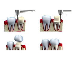Root Canal Service Tysons Corner | Get Your Healthy Smile Back | Smile Perfectors   | free-classifieds-usa.com - 1