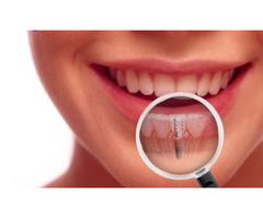 Dental Implants Frisco TX | free-classifieds-usa.com - 1