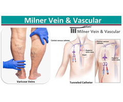 Varicose Veins Treatment With Tunneled Catheter | free-classifieds-usa.com - 1