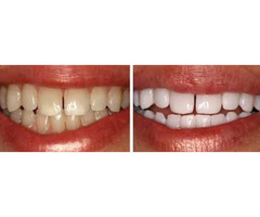 Best Teeth Whitening Dentist in Manhattan | free-classifieds-usa.com - 1