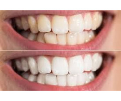 Teeth whitening services in Houston | free-classifieds-usa.com - 1