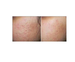 Glycolic Acid For Acne - Karmina Beauty Clinic | free-classifieds-usa.com - 1