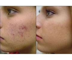 Glycolic Acid For Acne - Karmina Beauty Clinic | free-classifieds-usa.com - 2