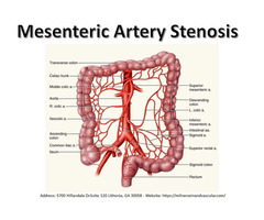 Mesenteric Artery Stenosis Treatment | free-classifieds-usa.com - 1