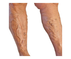 One of the Best Varicose Vein Doctor In New York | free-classifieds-usa.com - 1