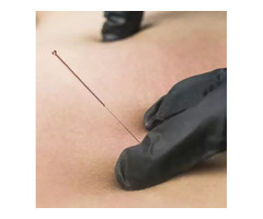 Try dry needling for thorough relief | free-classifieds-usa.com - 1