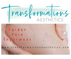Spider Vein Treatment - That Help You Get Rid of Scars | free-classifieds-usa.com - 1