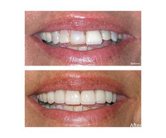 Professional Teeth Whitening Nokomis | Dr. Keith Blessitt - We Make Smiles | free-classifieds-usa.com - 3