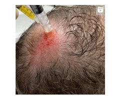 Microneedling for Hair Lose - Karmina Beauty Clinic | free-classifieds-usa.com - 1