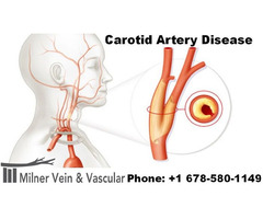 Carotid Artery Disease Treatment in Lithonia | free-classifieds-usa.com - 1